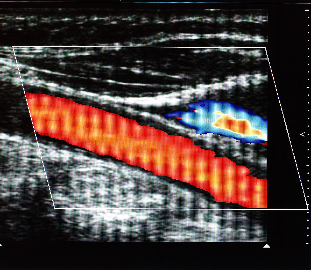 CAROTID ULTRASOUND 2 | Carolina Primary Care : Carolina Primary Care