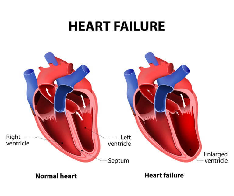 congestive-heart-failure-carolina-primary-care