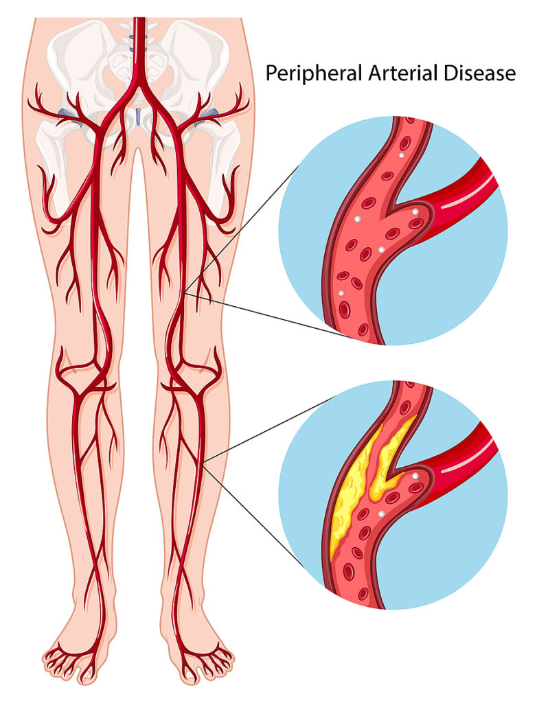 Peripheral Arterial Disease Carolina Primary Care